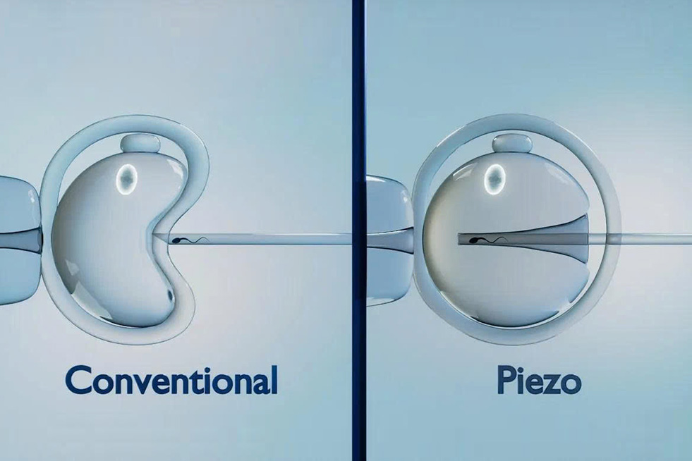 PIEZO ICSI giúp tăng tỷ lệ thụ tinh so với ICSI truyền thống