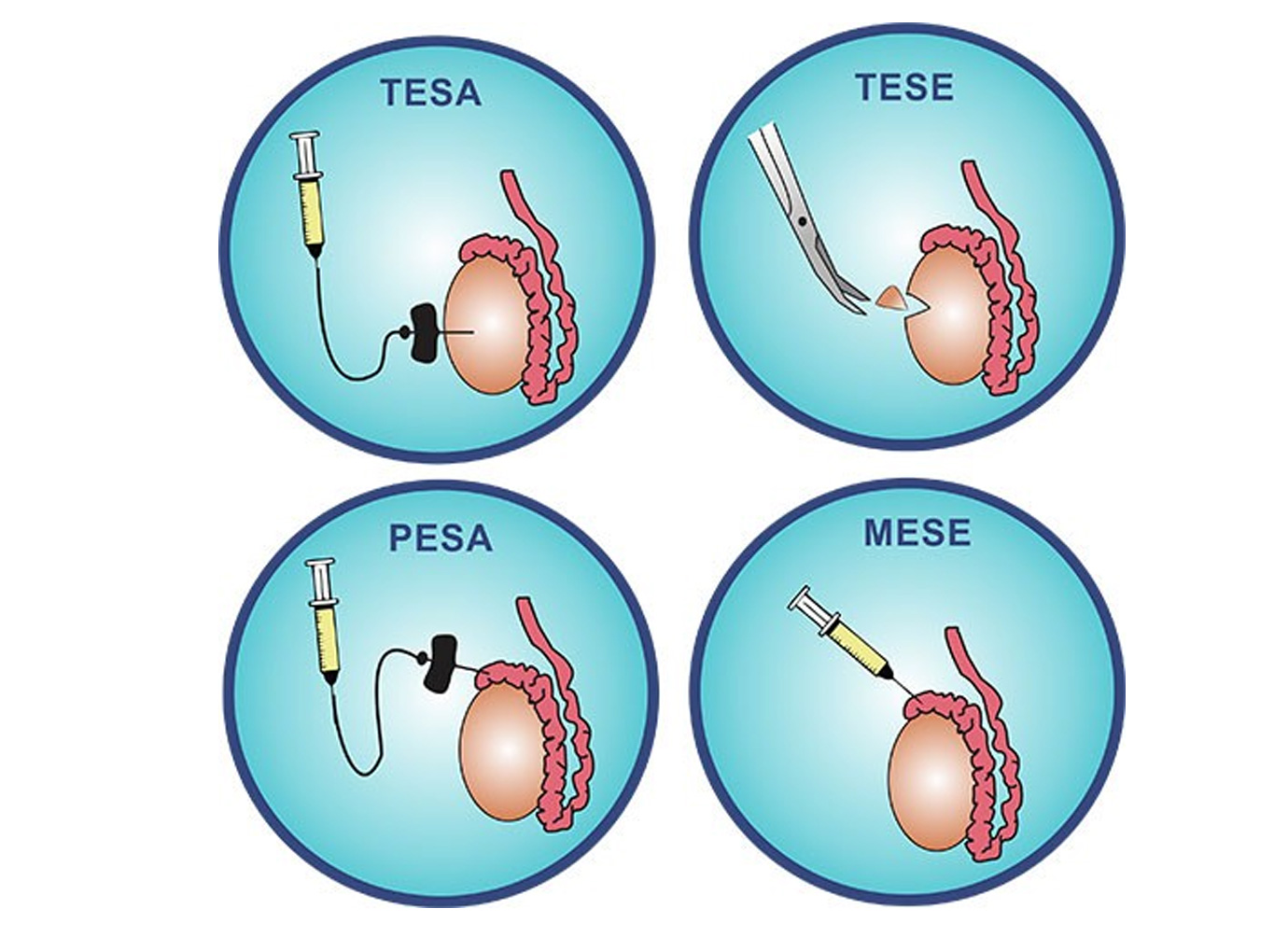Phẫu thuật lấy tinh trùng từ mào tinh