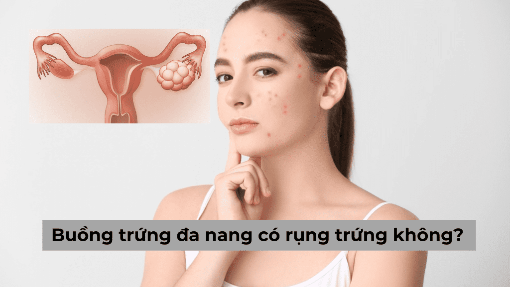 Buồng trứng đa nang có rụng trứng không