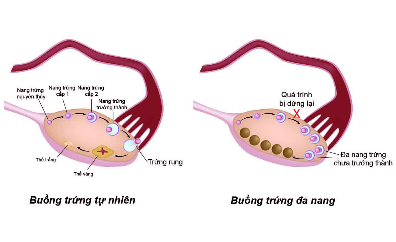 Buồng trứng đa nang tiếng anh