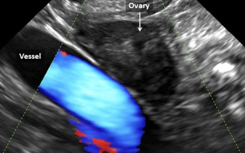 Cắt 1 bên vòi trứng có làm IVF được không