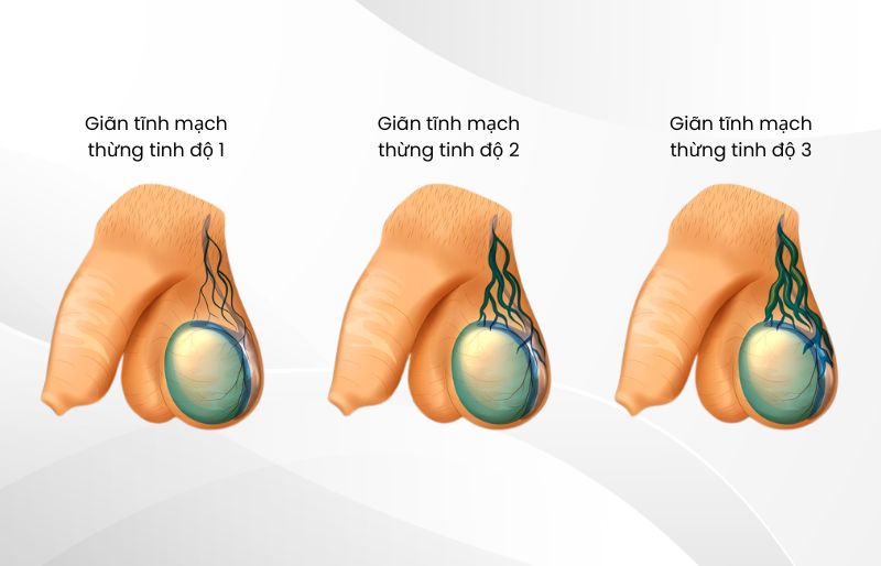 Giãn Tĩnh Mạch Thừng Tinh (Varicocele)
