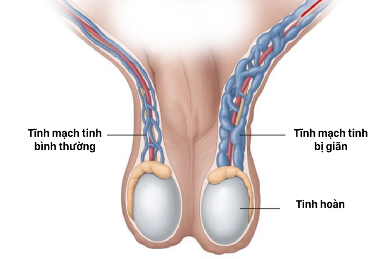 Giãn tĩnh mạch thừng tinh là gì