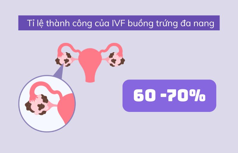 Kích trứng cho buồng trứng đa nang