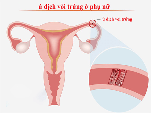 ứ dịch vòi trứng