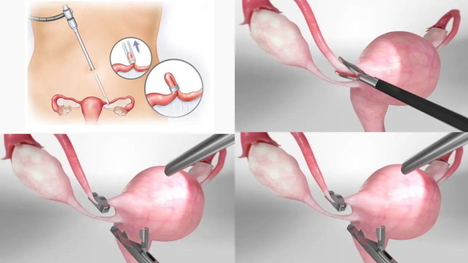 Tắc vòi trứng có kinh nguyệt không