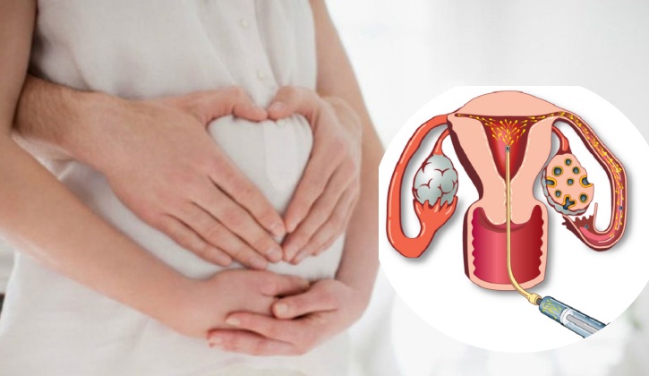 Tại sao bị đa nang buồng trứng