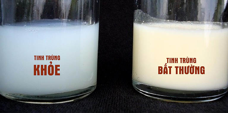 Tinh dịch không có tinh trùng màu gì