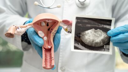 buồng trứng đa nang