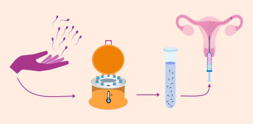 buồng trứng đa nang ivf