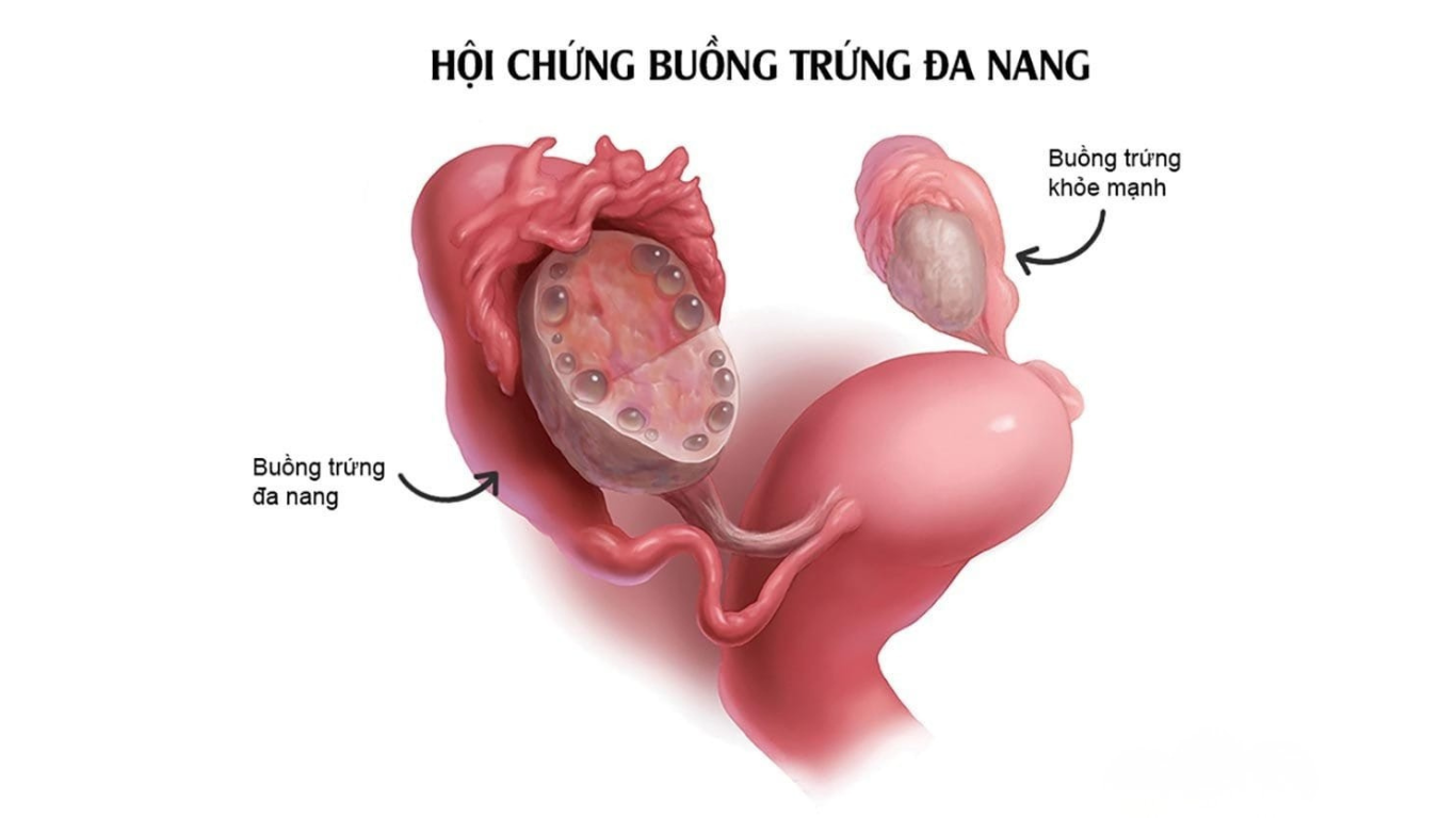 buồng trứng đa nang PCOS