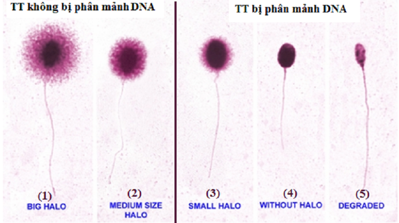 kỹ thuật Halosperm để đánh giá độ đứt gãy DNA (SDF)