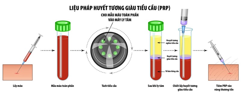 kỹ thuật PRP (Bơm huyết tương giàu tiểu cầu)