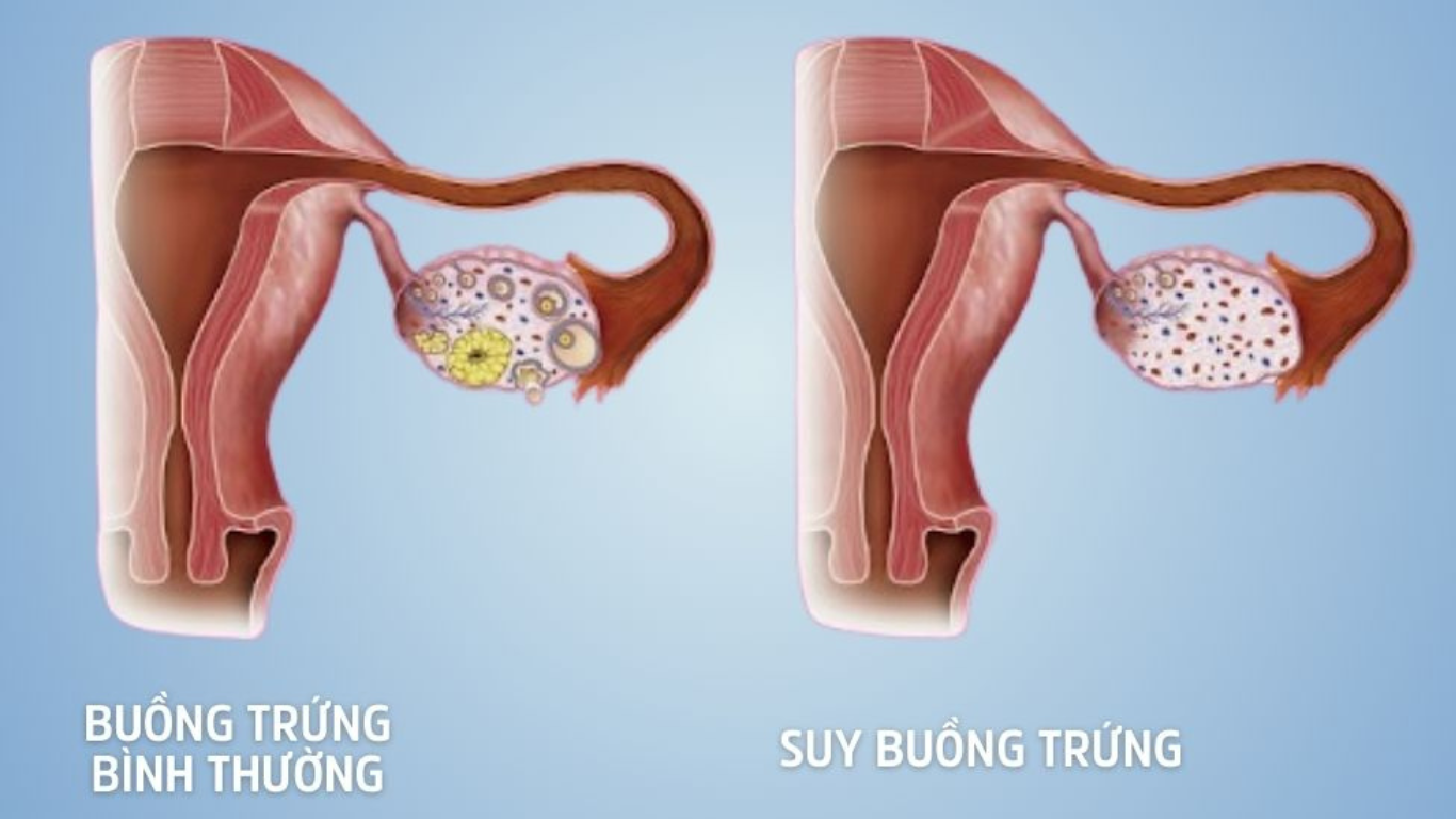 Suy buồng trứng sớm POI