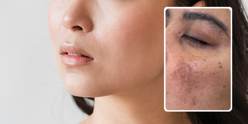 vết sạm nám do mất đi sự hỗ trợ của collagen