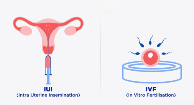 IUI khác IVF như thế nào