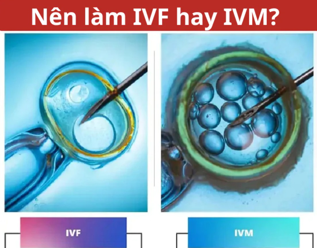 Kinh nghiệm làm ivm thành công