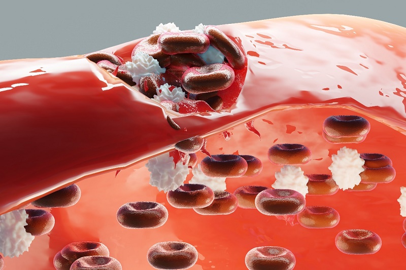 máu khó đông Hemophilia